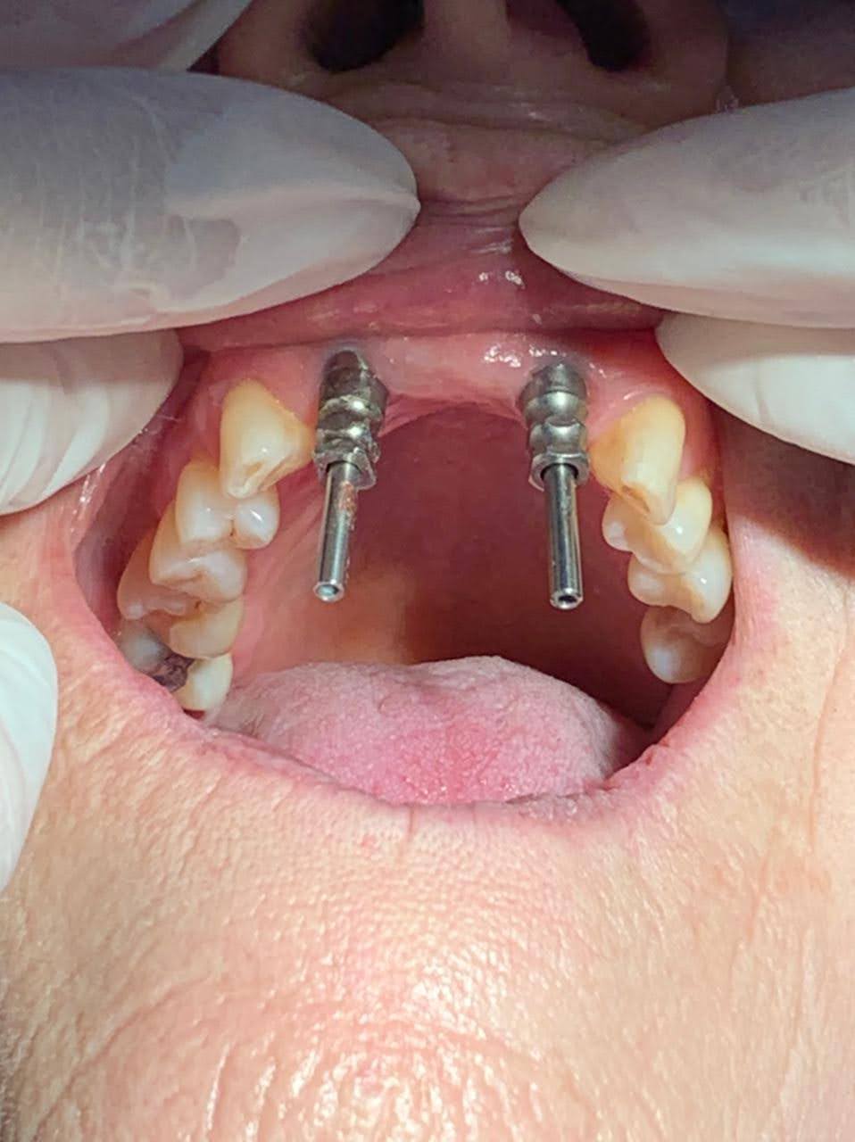 Diagrama de Implante Dentário